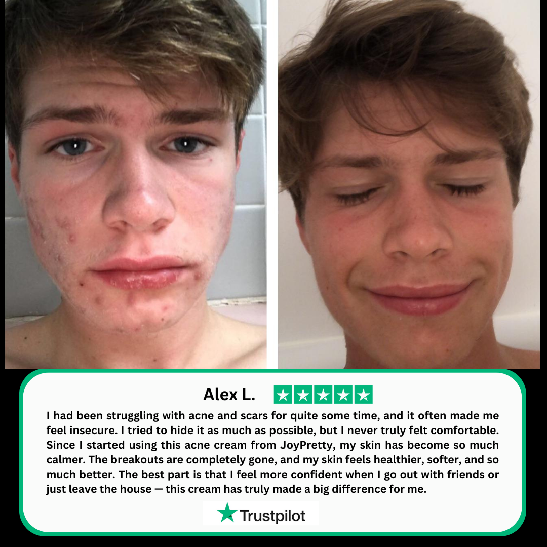 Herbal acne cream