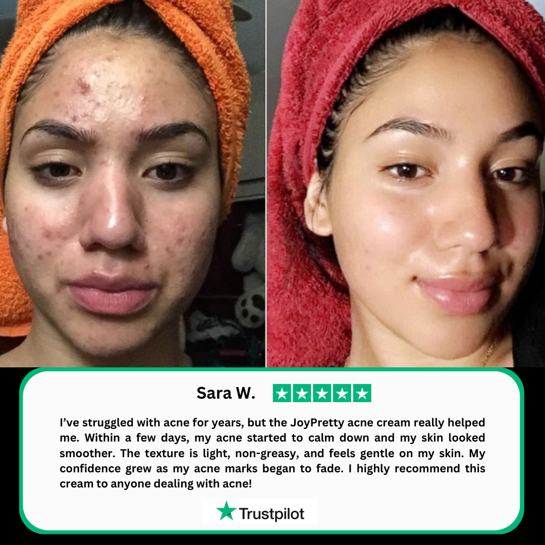 Herbal acne cream